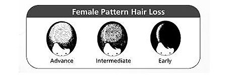 Beijing 101 female pattern hair loss baldness treatment consultant qualified abnormal normal